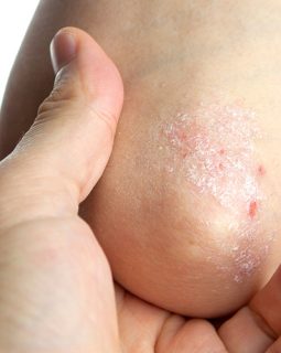 TRATAMIENTO DE PSORIASIS